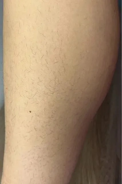 Braun IPL Skin i·expert účinek