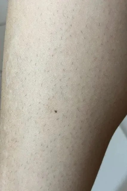 Braun IPL Skin i·expert zkušenosti