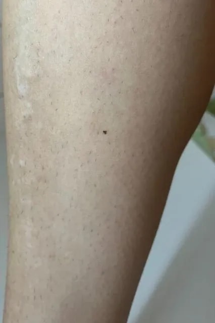Braun IPL Skin i·expert jak funguje