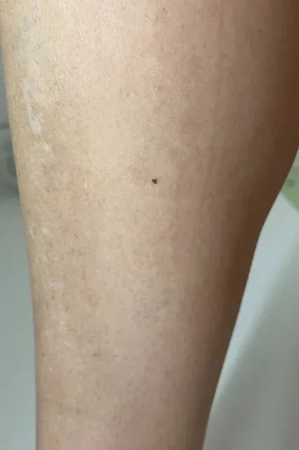 Braun IPL Skin i·expert hodnocení