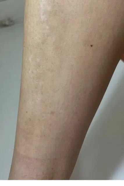 Braun IPL Skin i·expert testování